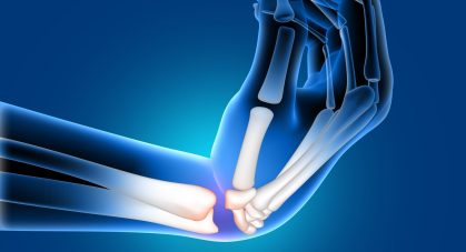 3d-medical-image-painful-bent-wrist_1048-8186
